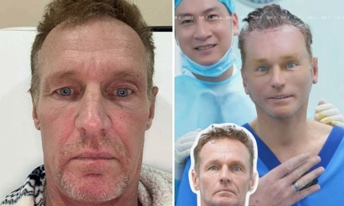 Touriste australienne devient sensation sur les réseaux sociaux après une chirurgie esthétique à 4 000 $ au Vietnam !